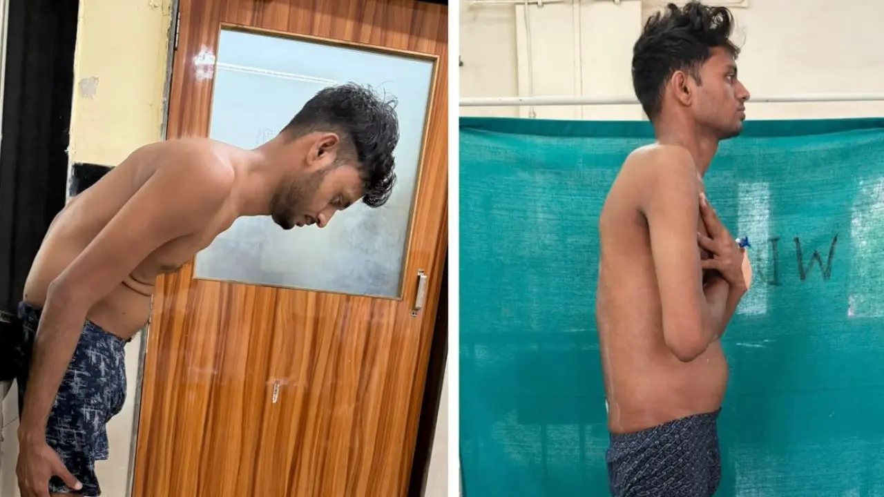 Mumbai doctors correct six-year spinal deformity in rare surgery on 32-year-old